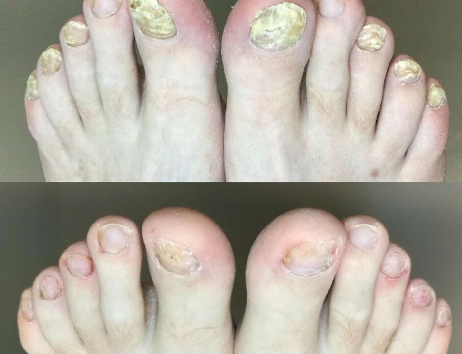 Avant et après le traitement, la crème de promotion des champignons