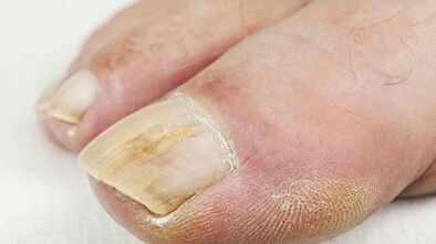Les raisons de l'apparence du champignon sur le pouce de la jambe