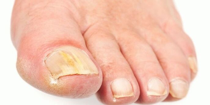 Produits efficaces du champignon des ongles