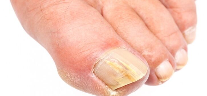 ongles affectés par des champignons