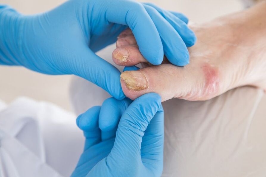 plaques à ongles affectées par des champignons