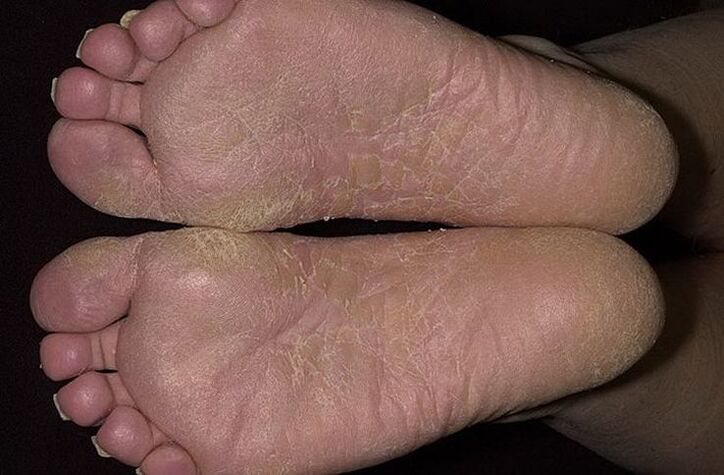 La peau sèche et squameuse des pieds est un signe de mycose squameuse