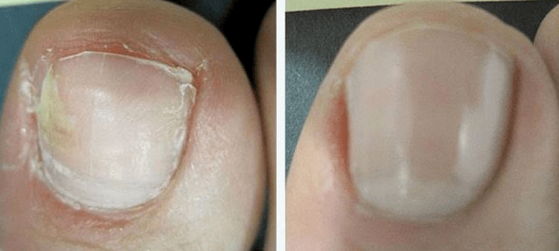 Ongles avant et après le traitement contre les champignons