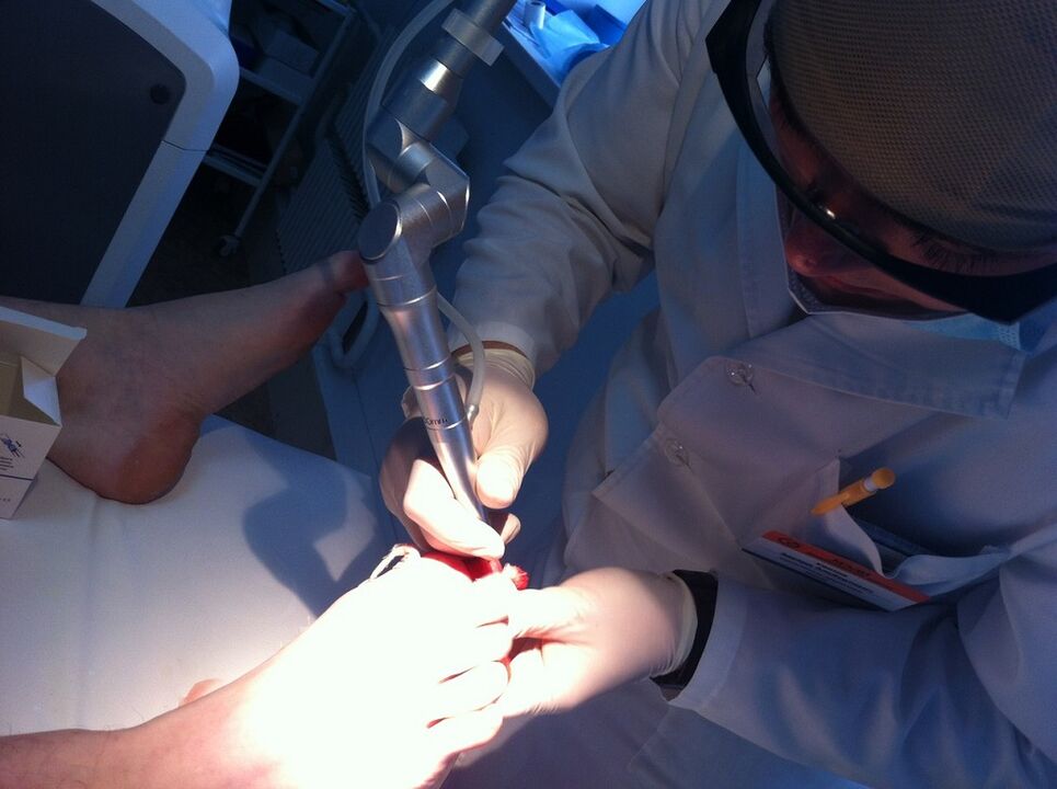 Traitement laser de la mycose